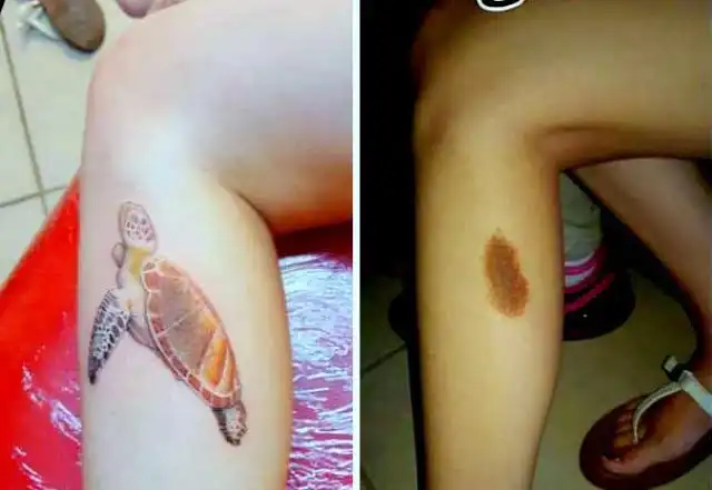 Can You Tattoo Over Birthmark