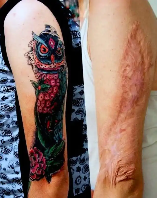 Can You Tattoo Over Burn Scars
