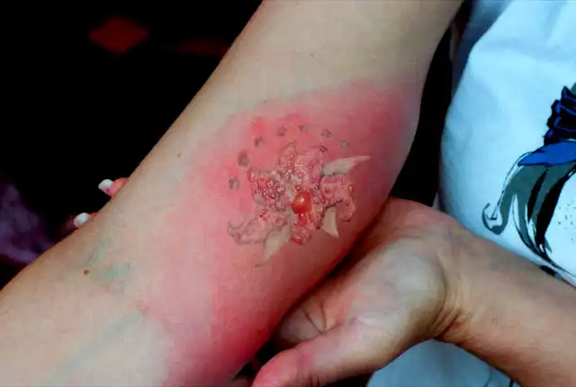 How To Treat An Infected Tattoo