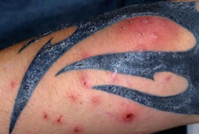 tattoo infection