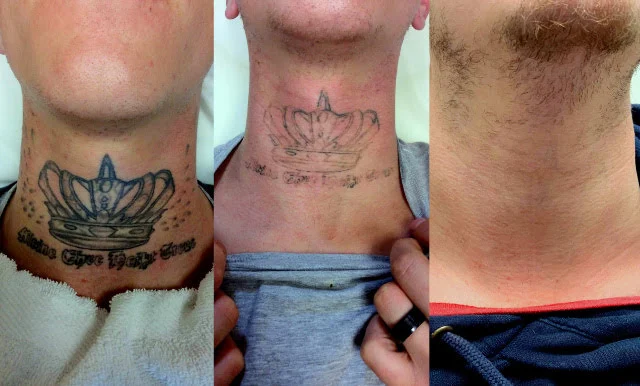 Tattoo Removal Before And After Picture